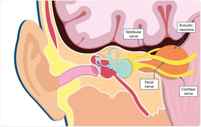 acoustic-neuroma.jpg