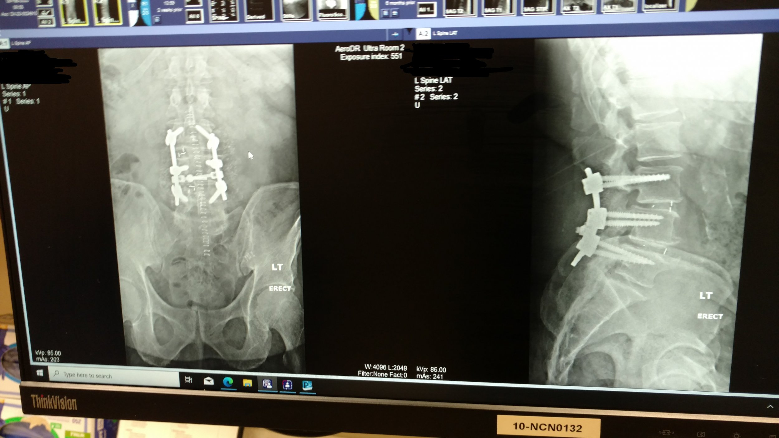 Lumbar Surgery Repair.jpg