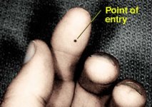 34-73689-Fluidhandinjuryentrywound.jpg
