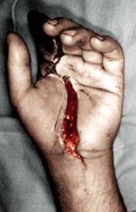 34-73690-Fluidhandinjuryexitwound.jpg