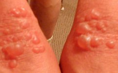blisters.jpg