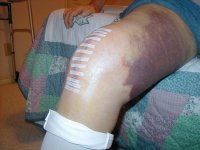 New Knee 004.JPG