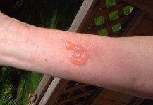 440108-rash.jpg