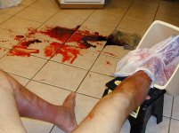 Ankle Bleeding Episode (3).jpg