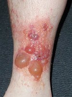 rash.jpg