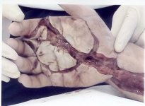 fluid injury1.jpg