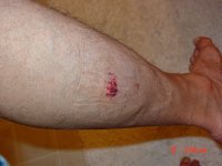 Dog bite on left leg 002.jpg Dog bite on left leg 002.jpg