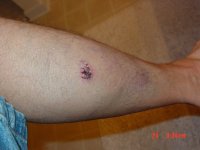 Dog bite on left leg 005.jpg