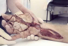 oil-injection-injury-hand.png