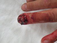 finger injury  5-18-2012 002_1.JPG