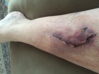 Day after stitches removed 3.JPG