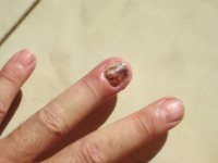 finger injury 6 weeks 001_1.JPG