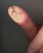 ThumbWound.jpg